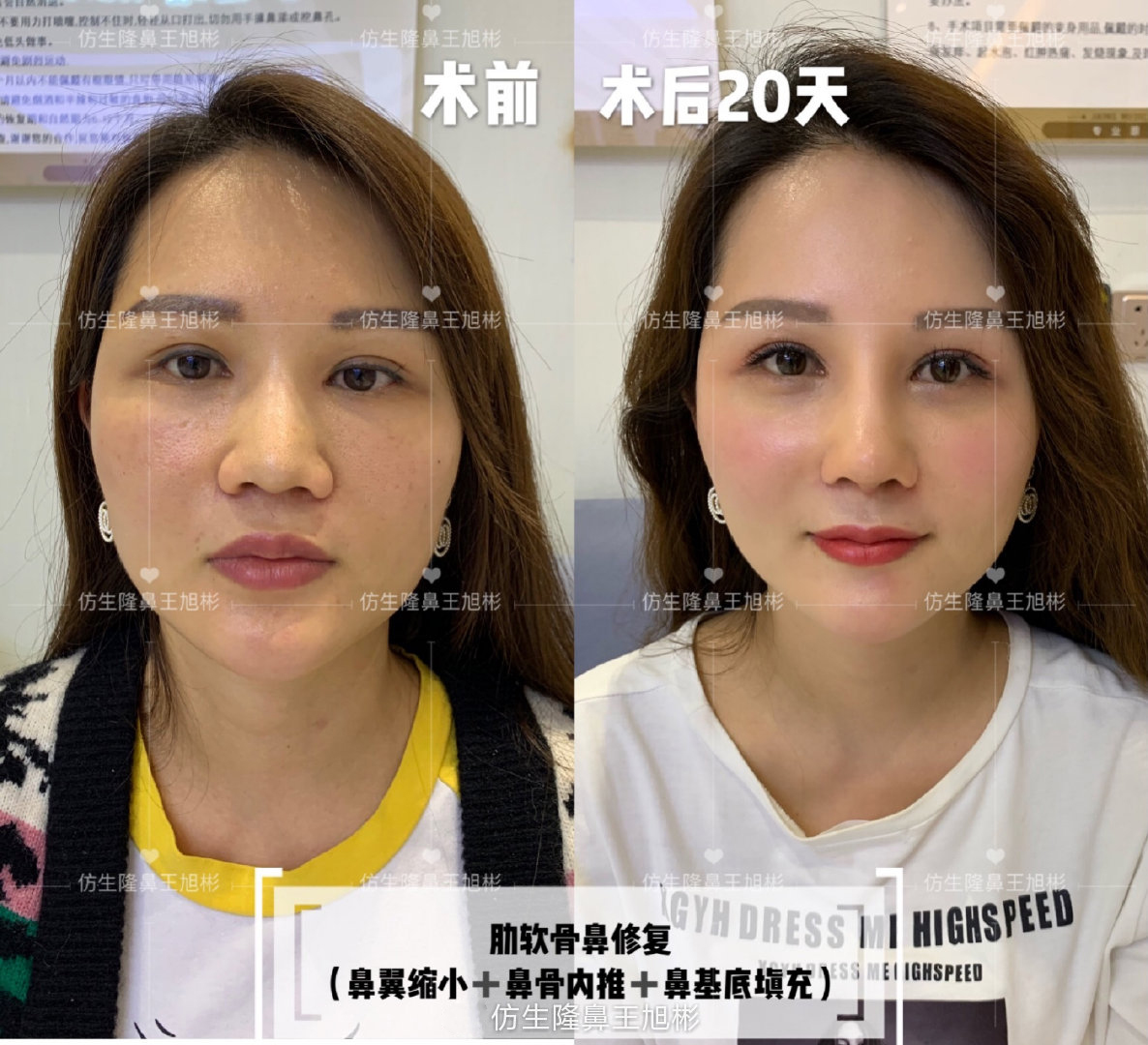 缩鼻翼可以改善鼻翼下垂吗,鼻翼肥大之鼻翼缩小术你见过吗