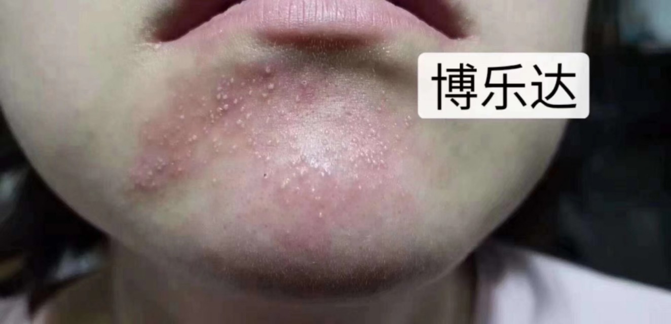 祛黑头痘印痘坑测评,净痘印去黑头精华推荐