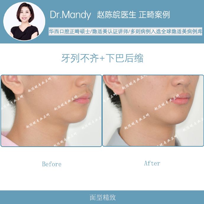 杭州牙齿隐形矫正,杭州成人隐形矫正牙齿优惠