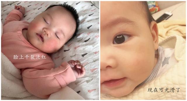 1岁半孩子湿疹反反复复怎么根除,1岁半宝宝湿疹反复发作怎么回事