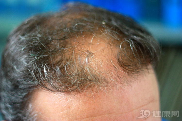 市面上的防脱发生发靠谱么,网上的防脱生发是真是假