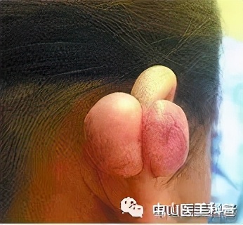 疤痕祛除咨询,一些疤痕的治疗效果图