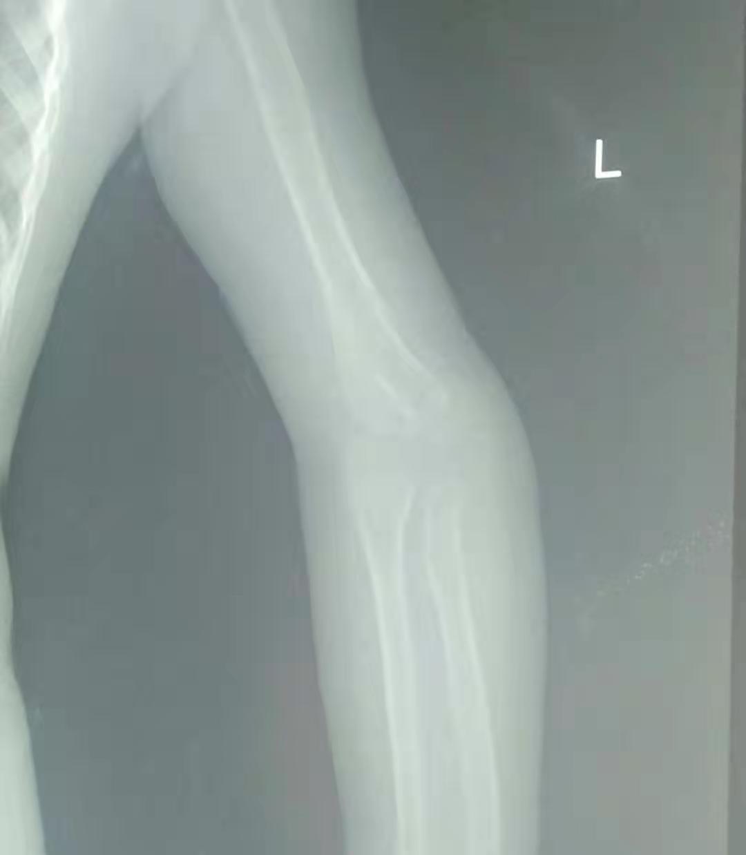 骨折复位错位1.4毫米有影响么,骨折错位一个月还能手法复位吗