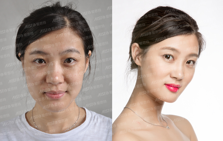 做了激光祛斑后吃什么好,皮秒激光和激光祛斑