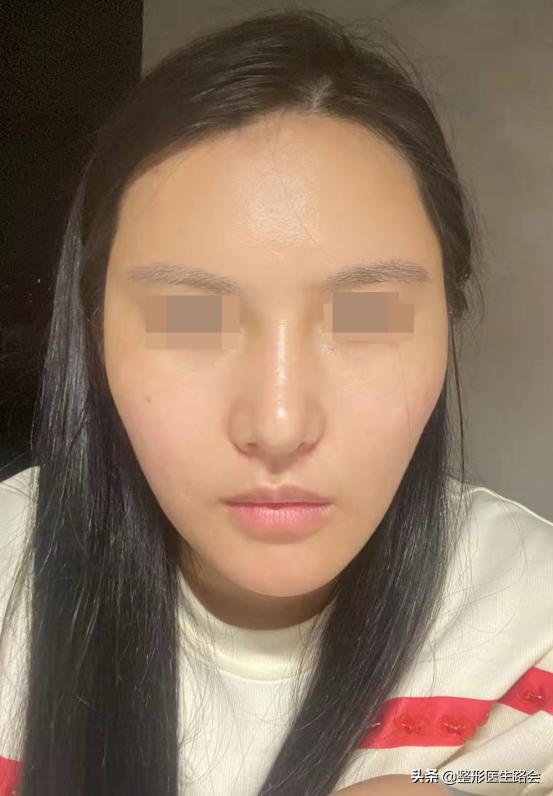 做的耳软骨鼻塌下去了怎么修复啊,做了耳软骨鼻如何不塌