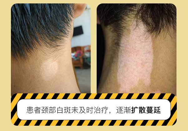 身上起小白点是什么原因怎么治,身上有一块白斑汗毛也是白的