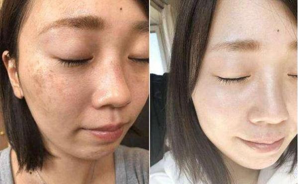 自制红糖面膜3天祛黑斑,红糖淡斑面膜