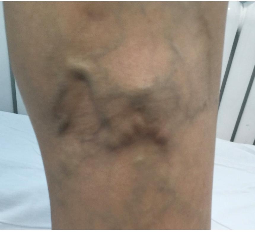 隔壁老王说静脉曲张可以打针治疗!这是真的吗?