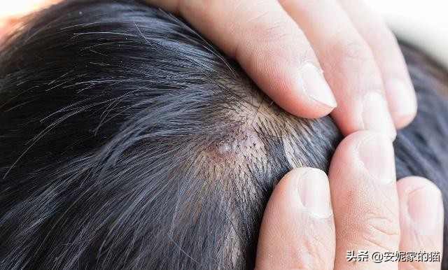 头皮长痘痘一招解决,头皮长痘痘瘙痒是什么原因