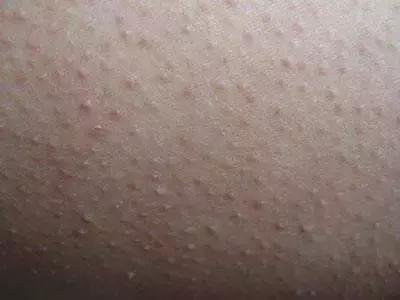 鸡皮肤女孩的自救法则,学生党怎么去除鸡皮肤最有效