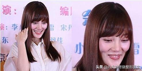 注射肉毒素脸部变化,肉毒素可以改变大小脸吗