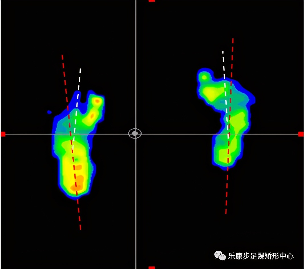 孩子有点内八字怎么矫正,一招解决儿童内八字