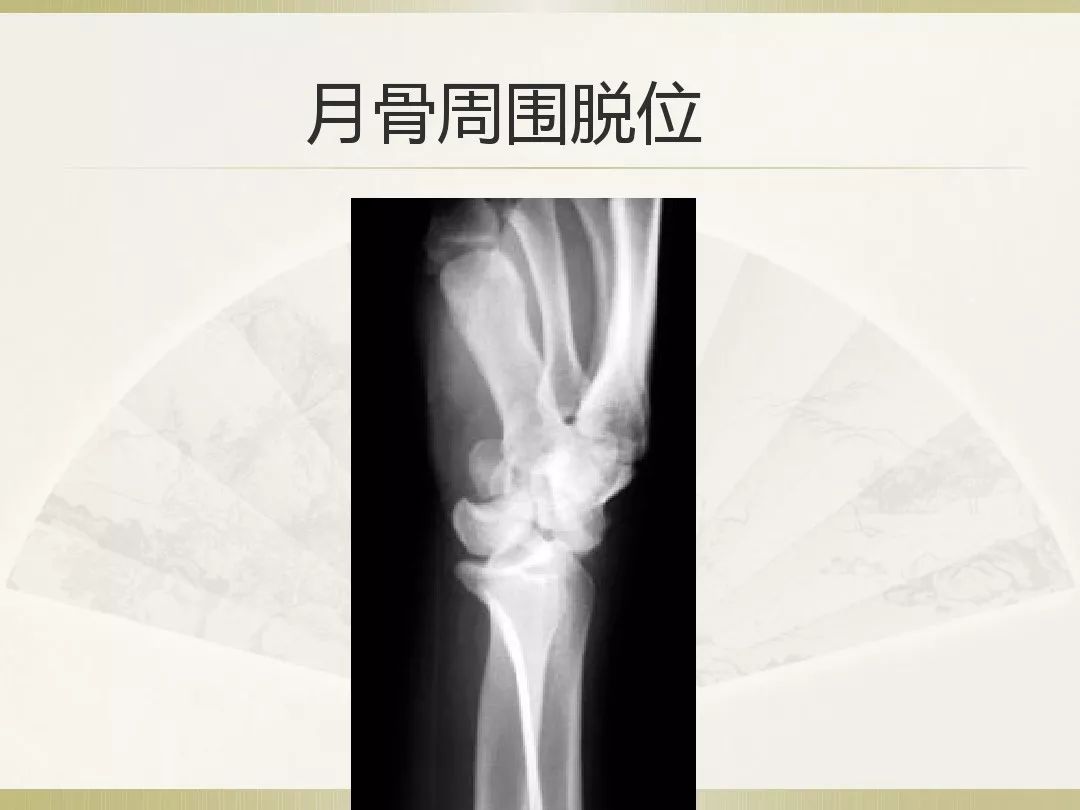 骨科x光片读片技巧,放射科骨科读片教程