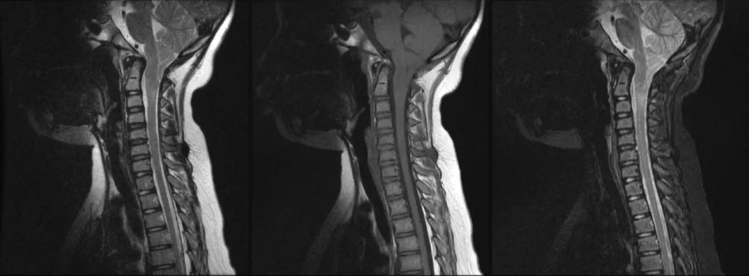 先天性颅脑发育不全,先天颅脑发育不良能治吗