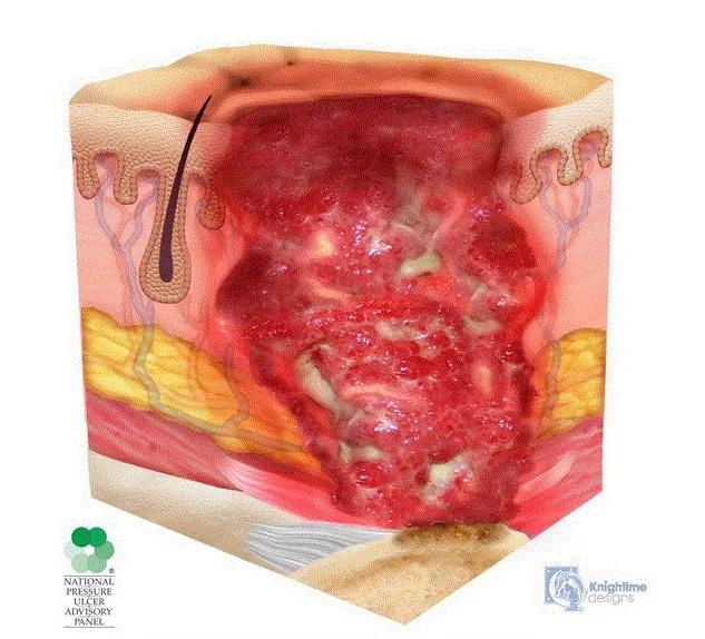 压疮情况要分期,严重危害需知道