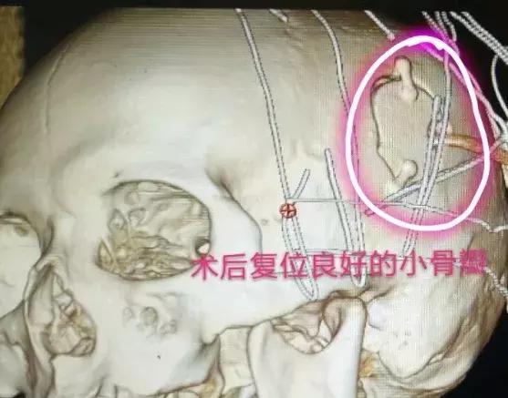 脑出血偏瘫的针灸治疗,脑出血能彻底治好吗