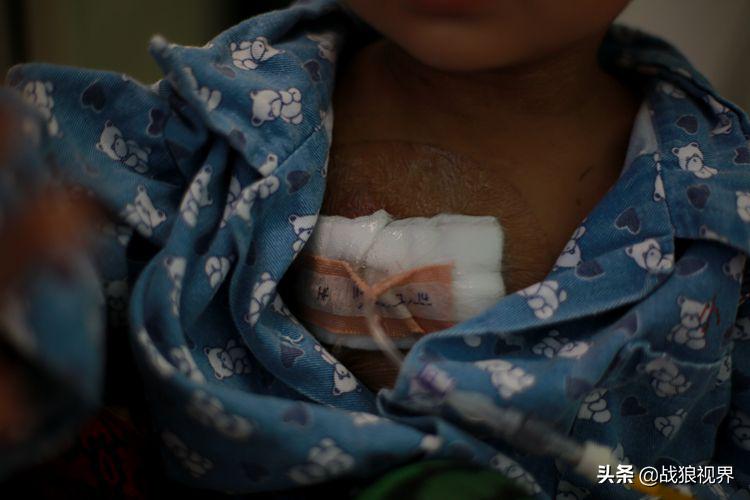 小孩摔一跤后引起眼袋淤青,2岁多男宝眼袋浮肿有点发紫