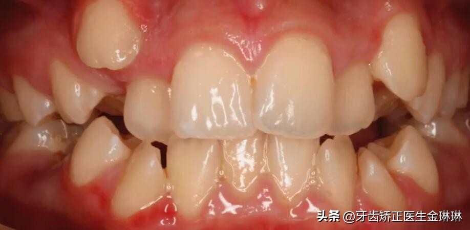 牙齿不整齐导致蛀牙推荐矫正吗,有蛀牙和空牙可以先矫正吗