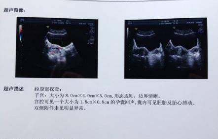 怀孕50天看孕囊大小真的准确吗,怀孕50天空孕囊B超