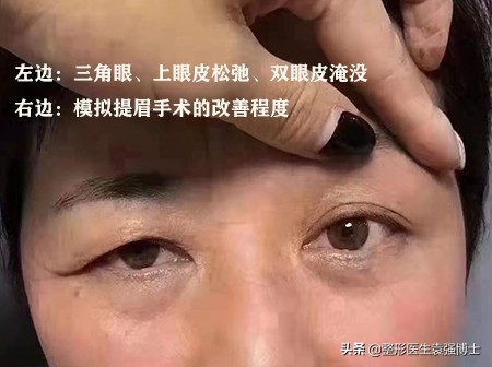 45岁眼皮耷拉下来怎么办,34岁上眼皮松弛需要提眉吗