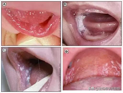 新生宝宝常见的问题--鹅口疮