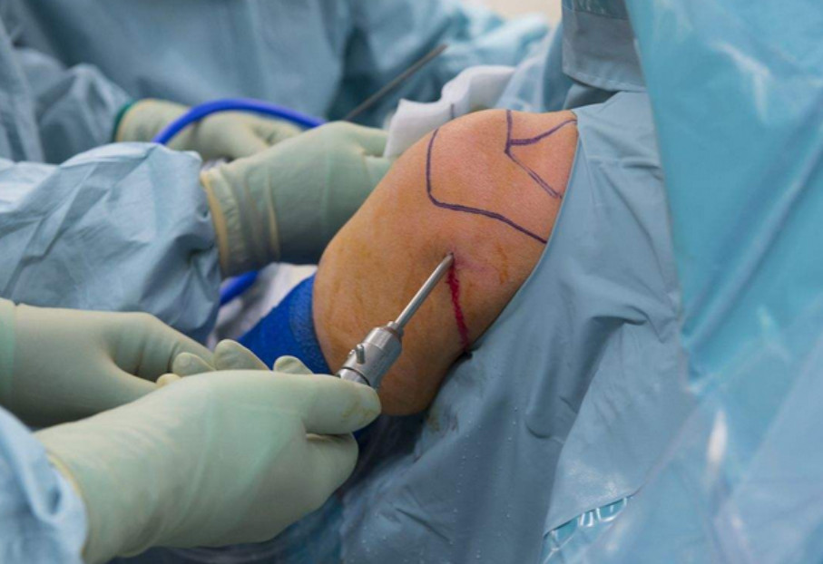 膝关节滑膜炎肿胀不消是怎么回事,膝关节不明原因疼痛是怎么回事