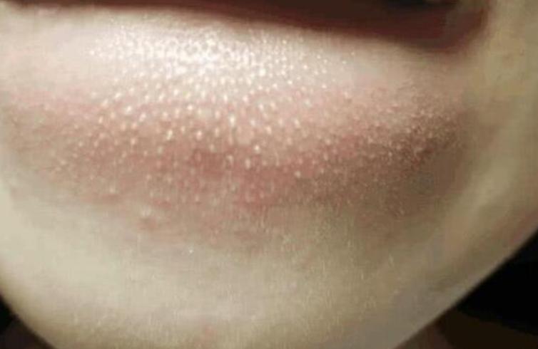 下巴凸起的白色颗粒怎么治,下巴上面白色小颗粒怎么治