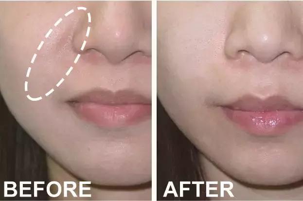 硬刚女皇龙妈也扛不住法令纹，2条沟壑让人心疼，贴一贴就消了