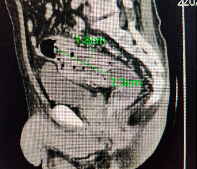 最近大便很细还拉肚子是怎么回事,平时身体挺好一生病就很严重