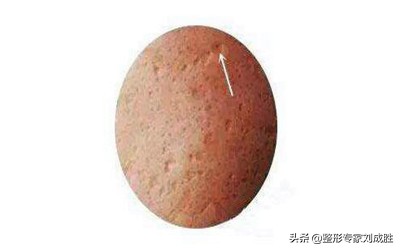 40来岁脸上的痘印痘痘怎么祛,脸上有痘坑痘印痘痘去哪里治疗