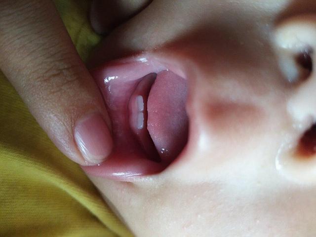 婴儿出牙顺序不正确是什么原因,你家宝宝长牙顺序图