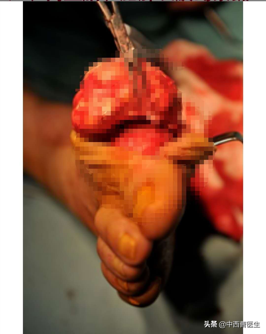 痛风的临床表现及健康教育ppt,痛风的诊断与治疗的内容