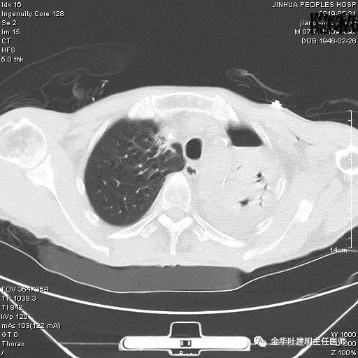 手术引起乳糜胸,有没有做了肺结节手术后是误诊的