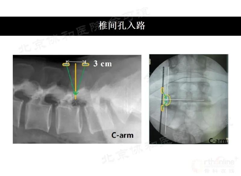 单侧双通道脊柱内镜技术优势,双通道脊柱内镜