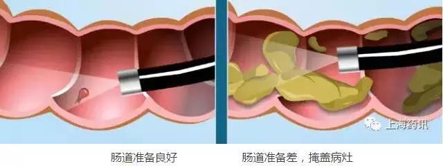 肠镜检查前，如何高质量准备肠道？