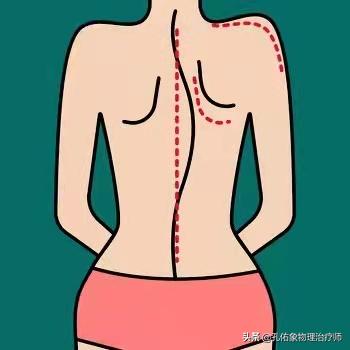 腰疼脊柱侧弯是什么样,腰痛引起的脊柱侧弯原因