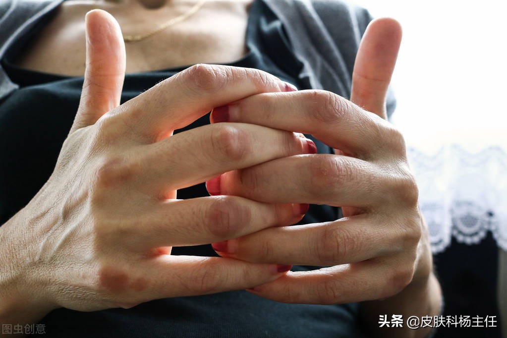 牛皮癣银屑病痒么,顽固性牛皮癣是银屑病吗