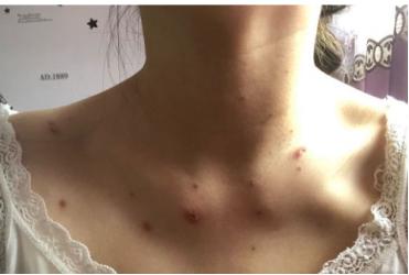 得水痘前兆是咽喉痛吗,水痘越来越多特别痒是不是快好了