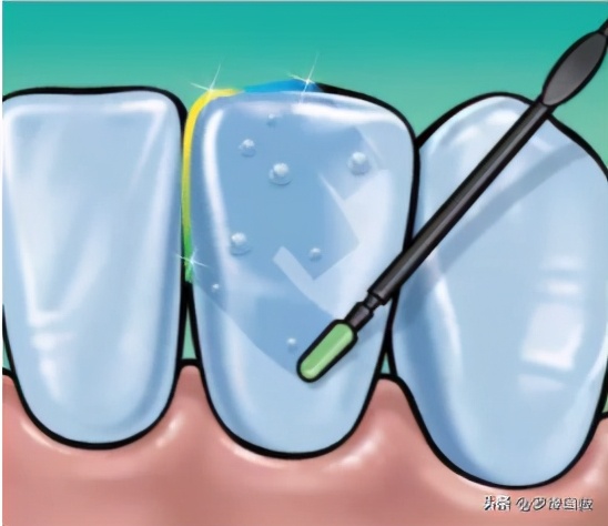 牙齿矫正后变黄怎么处理,矫正牙齿后牙齿为什么变黄了