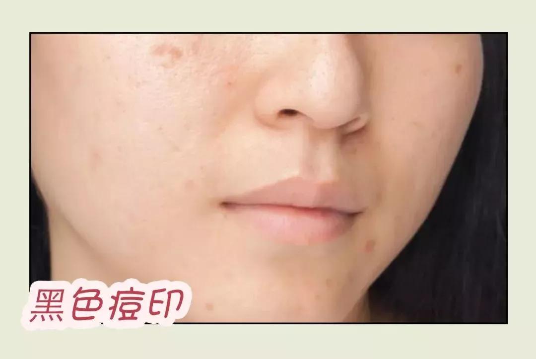 痘印痘坑怎么消除医美,十几年痘印痘坑消除的方法