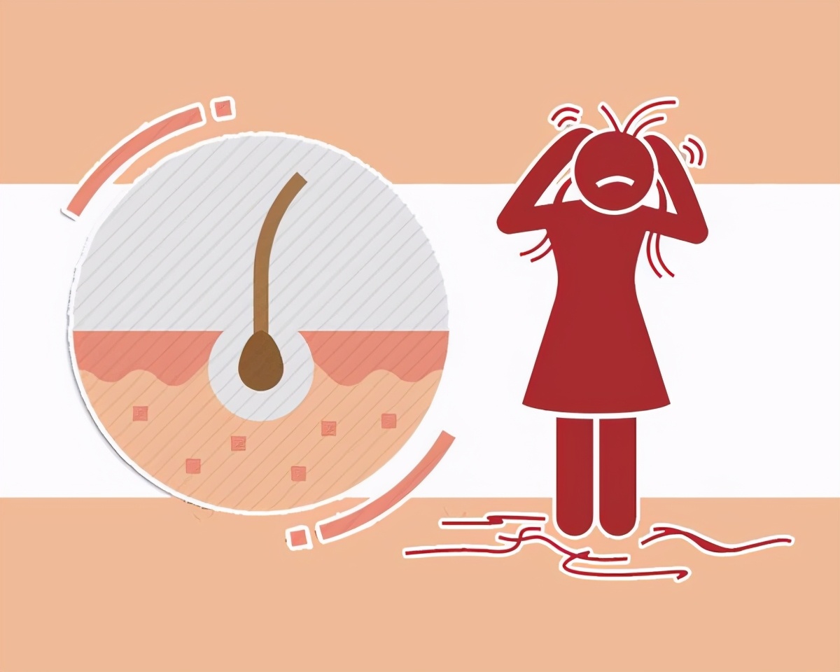 脂溢性皮炎脱发可以一天一洗头吗,脂溢性皮炎导致脱发怎么改善