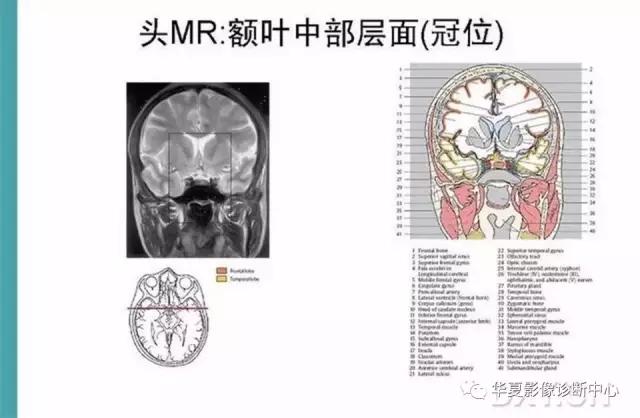 mra头颅解剖学详细讲解视频,常见的头颅mri图像