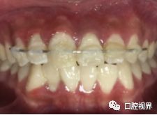 门牙受伤怎么办,门牙撞断了怎么办