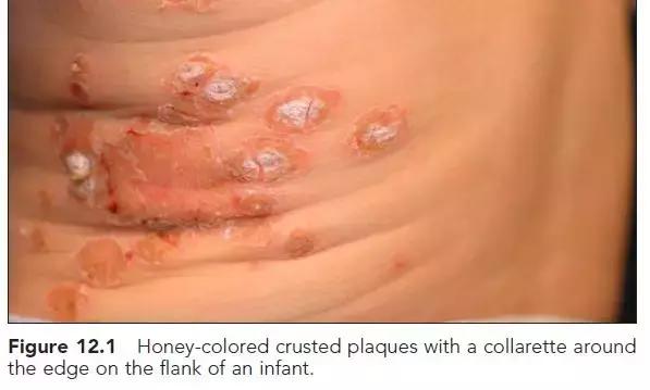 新生儿皮肤问题大全一览表,新生儿常见八大皮肤问题