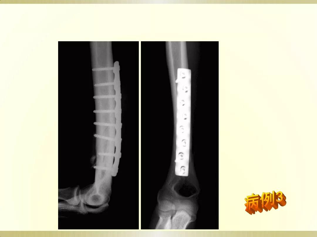 骨科x光片读片技巧,放射科骨科读片教程