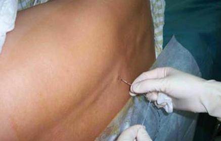 剖宫麻醉令妻儿变傻？医生有话要说