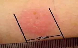 ppd皮试阳性症状,ppd皮试结果解读