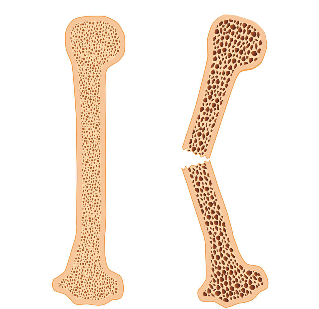 骨质疏松如何预防,骨质疏松我们该如何预防