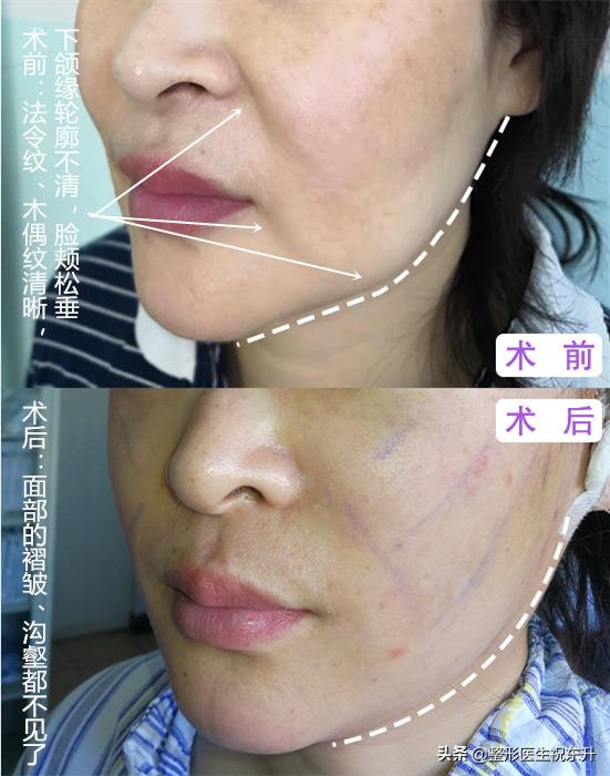 法令纹医院可以去除吗,法令纹能靠药膏解决吗