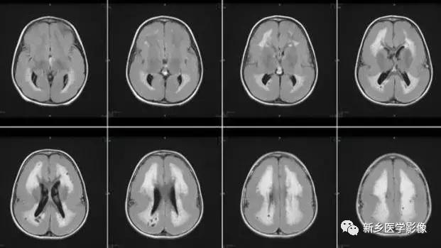脑室为什么会扩张,脑室为什么会变小